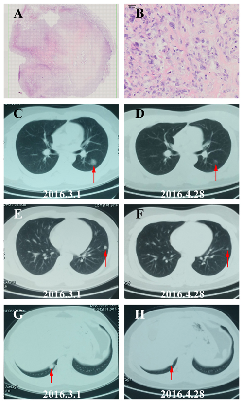 The image and pathological data of one PR patient with lung metastatic osteosarcoma.