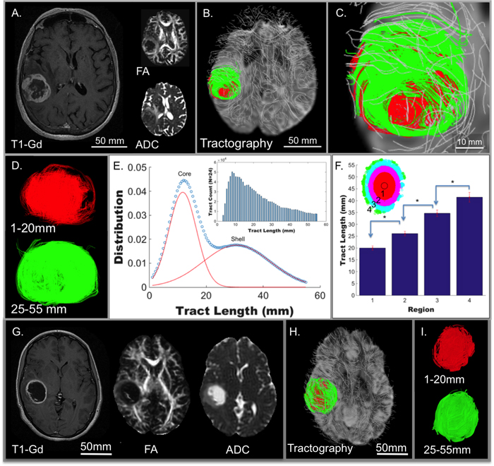 Tumor architecture derived in patients from The Cancer Genome Atlas (TCGA) glioblastoma study (