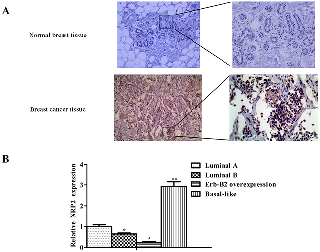 NRP2 expression is negatively related to the expression of miR-196a-3p in breast cancers.