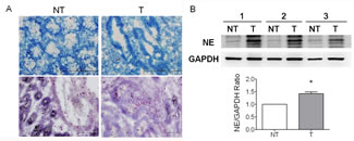 Neutrophils highly accumulated in the tissues of colorectal cancer (CRC).