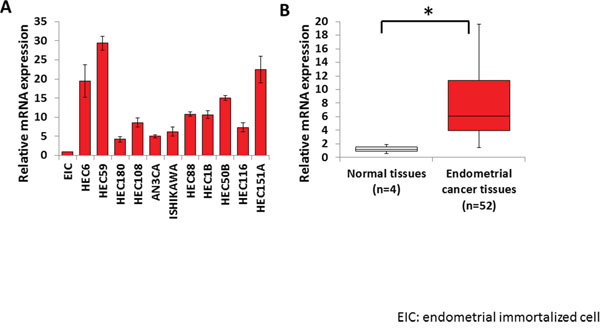 High EZH2 expression in endometrial cancer.