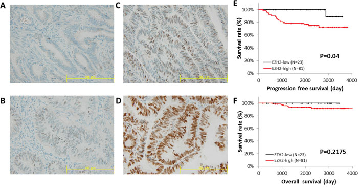 Immunohistochemical staining of EZH2 in a tissue microarray.