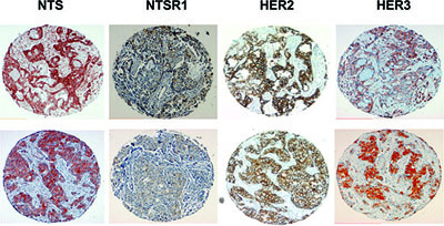 NTS, NTSR1, HER2, and HER3 immunohistochemistry on breast and lung cancer tumors.