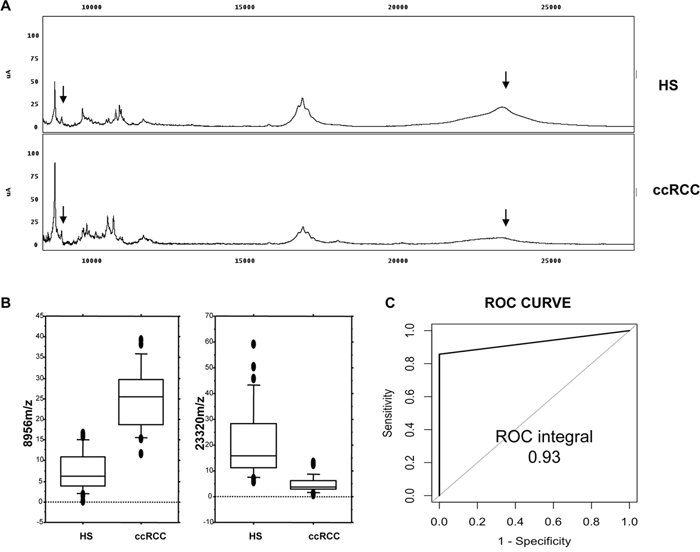 Recognition of ccRCC by urine protein profiling.