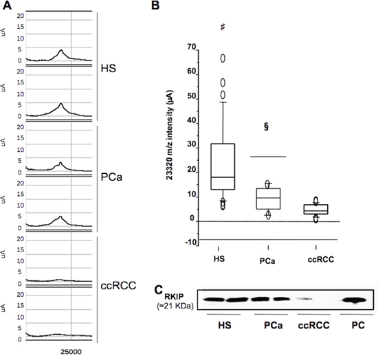 Selective reduction of urinary RKIP in ccRCC.