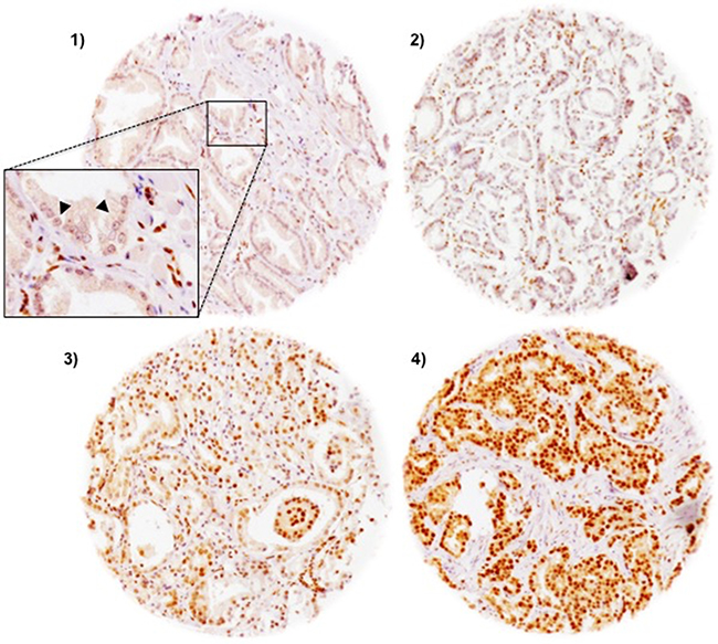 Representative pictures of FAM13C immunostaining in prostate cancer (100&#x00D7;).