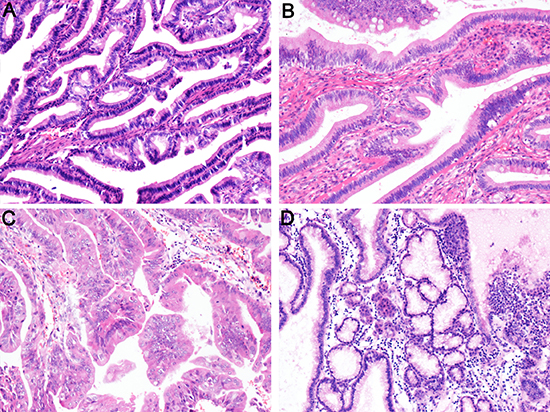 Histological subtypes identified in IPNG and IPNB.