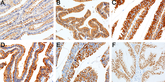 Expression of immunohistochemical markers in tumor cells.