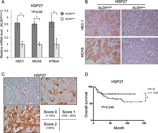 HSP27 expressed in ALDH1high cells derived from endometrial and ovarian carcinoma.