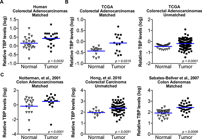 TBP is increased in a statistically significant number of human colorectal tumors compared to normal tissue.