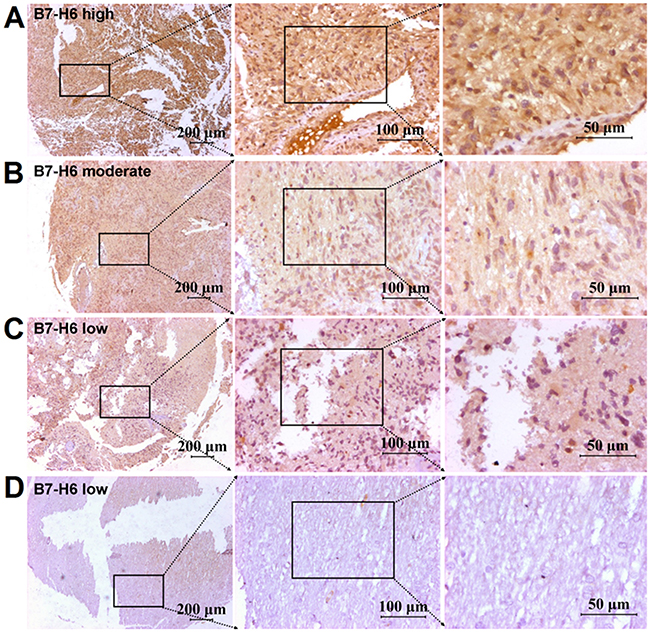 Immunohistochemical staining of B7-H6 in human glioma tissues.
