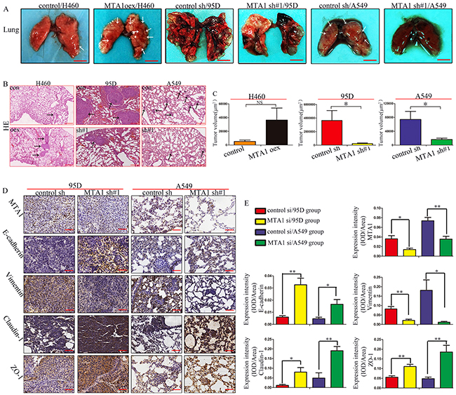 MTA1 knockdown inhibits lung metastasis by regulating EMT in vivo.
