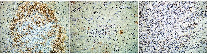 Immunohistochemical staining for programmed death-1 ligand-1 (PD-L1) and programmed death-1 (PD-1) in gastric signet-ring cell carcinoma (SRCC) tissue.