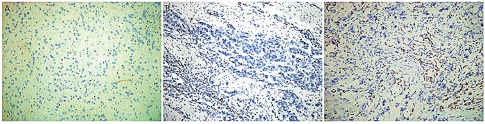 Immunohistochemical staining for CD3+ TILs infiltration in SRCC tissue.