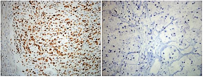 Immunohistochemical staining for MLH1, MSH2, MSH6 and PMS2 in SRCC tissue.