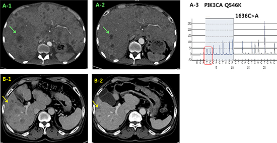 Representative clinical responses of 2 PIK3CA mutant cases in the matched group that were treated with the combination of an Akt inhibitor and paclitaxel.