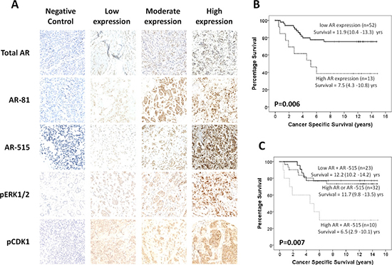 AR-515 is associated with poorer patient survival in triple negative breast cancer.