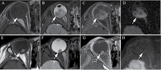 Clinically diagnosed retinoblastoma in a 24-month old male (patient 1).