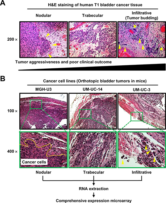 Representative images of H&#x0026;E-stained specimens of three tumor growth patterns in human UCB (A) and bladder tumors in an orthotopic animal model (B).