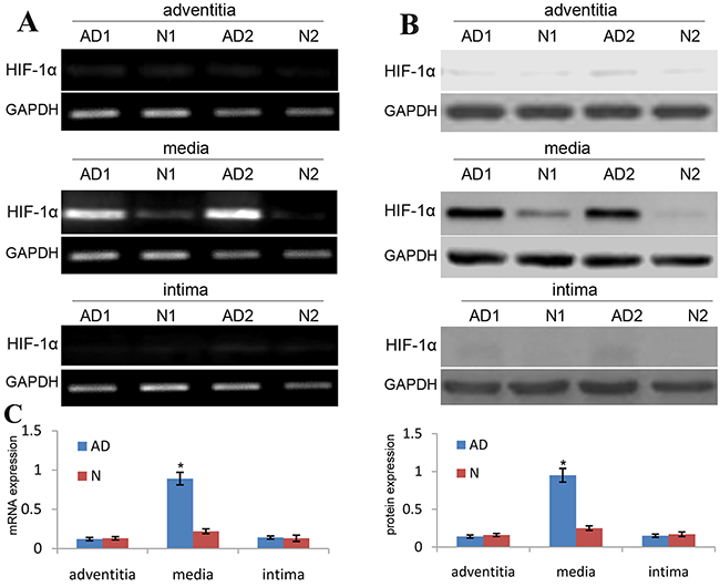HIF-1&#x03B1; expression is upregulated in media of TAD specimens.