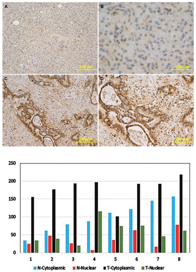 The expression levels of KRT16 protein in paired tumor and benign pancreatic tissues from patients who underwent resection for PDAC.