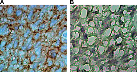 Comparisons of AQP5 expressions in primary glioblastoma and normal brain tissue detected by IHC (&#x00D7; 400).