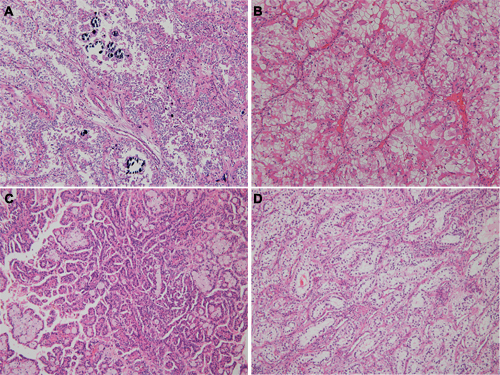 Morphologic features of translocation renal cell carcinoma, according to fusion partners.