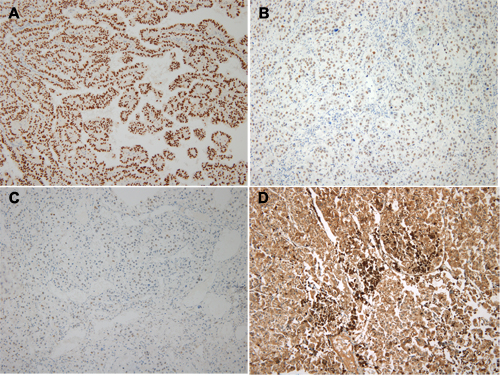 Immunohistochemical staining of TFE3 in Xp11 translocation renal cell carcinoma.