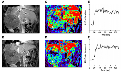 Representative DCE-MRI data in one advanced HCC patient.