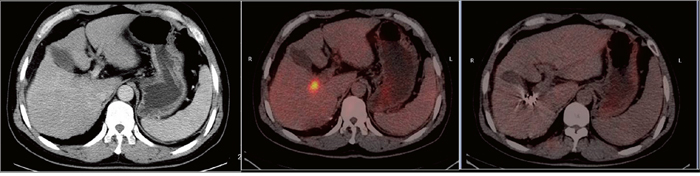A 45-year-old man with hepatocellular carcinoma complicated with portal vein tumor thrombus in the right branch.