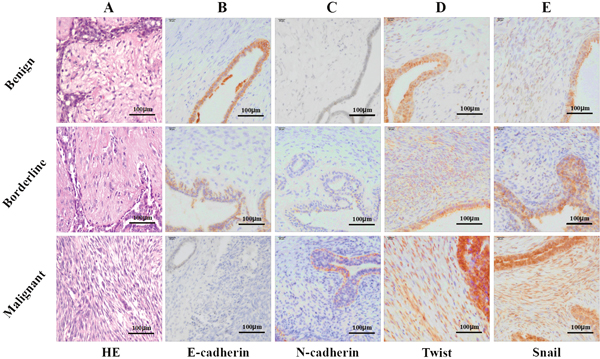 Representative photomicrographs of hematoxylin and eosin stain (H&#x0026;E) and immunohistochemical stain (IHC) for E-cadherin, N-cadherin, Twist and Snail.