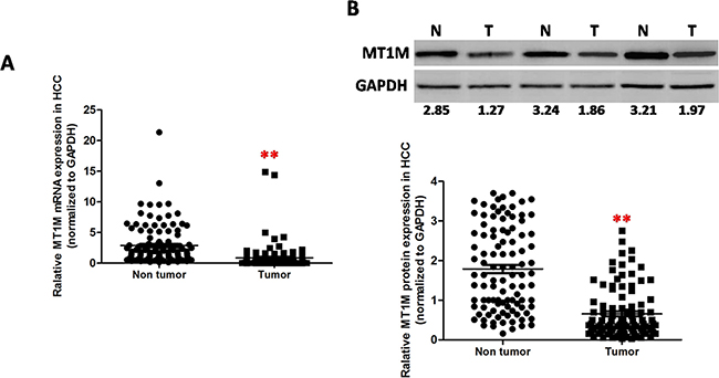 MT1M was downregulated in HCC tumor tissues.