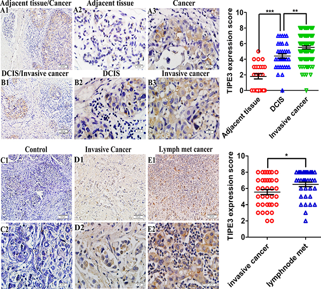 TIPE3 expression in breast cancer as determined by IHC. A1