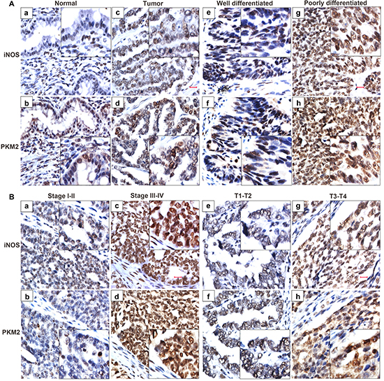 iNOS expression predicts an aggressive phenotype of ovarian cancer specimens.