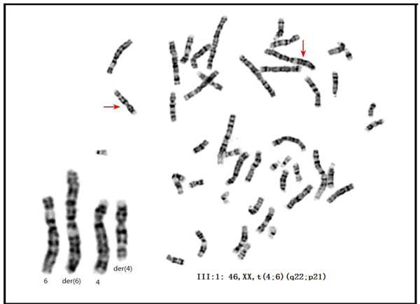 The karyotype of the proband of family 01.