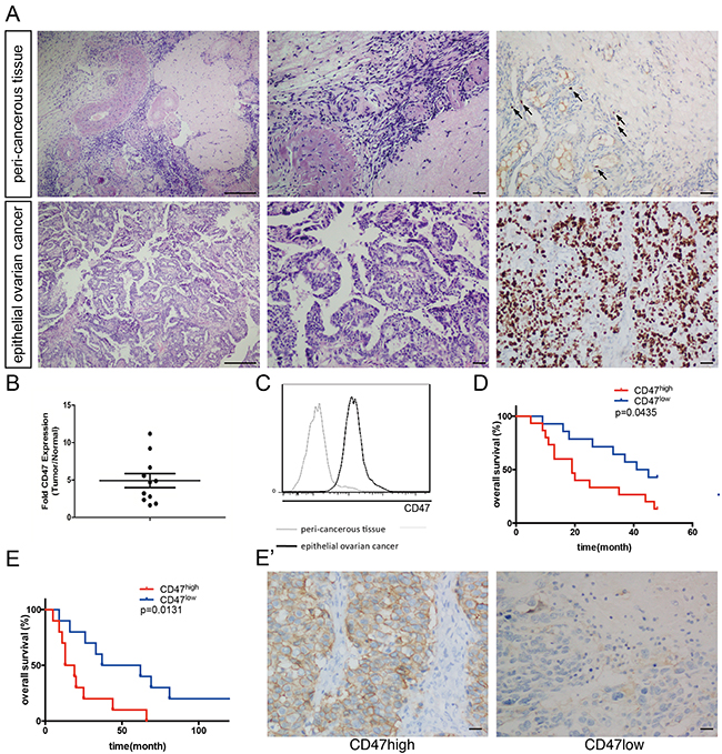 CD47 is highly expressed in ovarian cancer and correlates with poor clinical outcome.