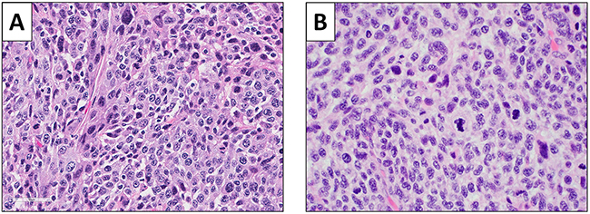 Histology of the original patient tumor and the untreated control PDOX tumor.