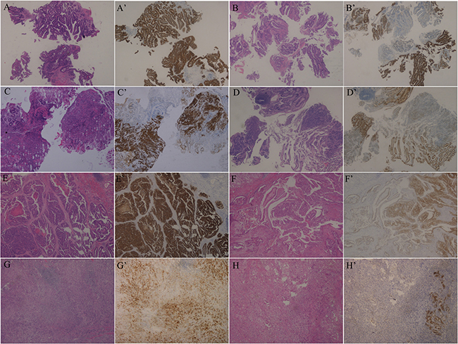 Examples of the 4 subgroups divided by combining HER2 heterogeneity and Lauren classification (HE and IHC, &#x00D7;50).