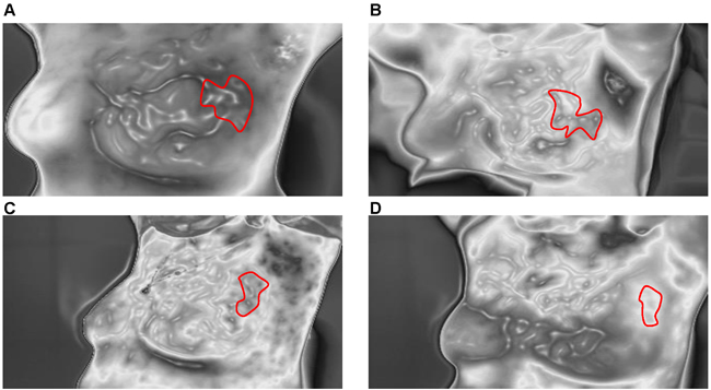 Blood vessel scans of a typical response before and after NAC.