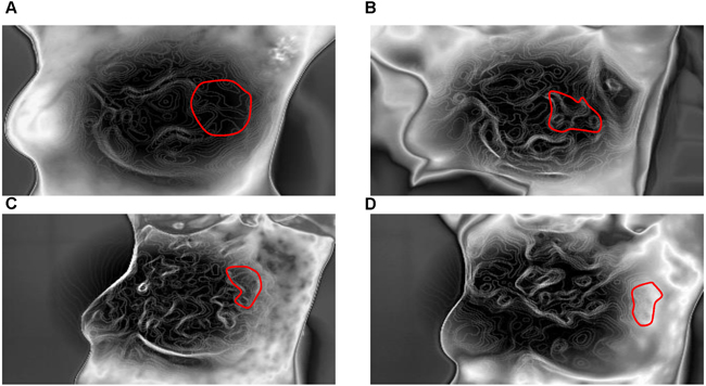 Isothermal images of a typical response before and after NAC.