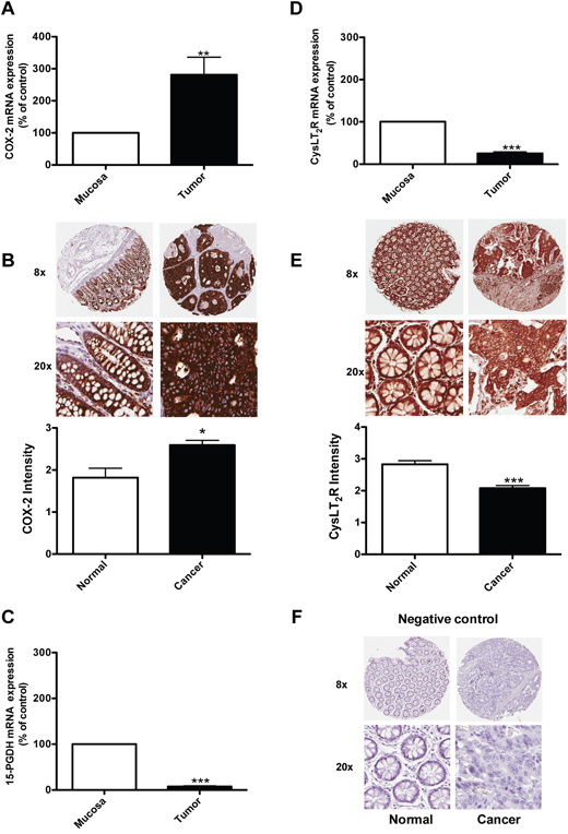 Expression of COX-2, 15-PGDH, and the CysLT2 receptor in colon cancer patients.
