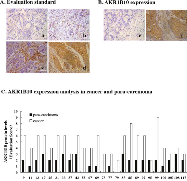 AKR1B10 expression in breast cancer tissues.