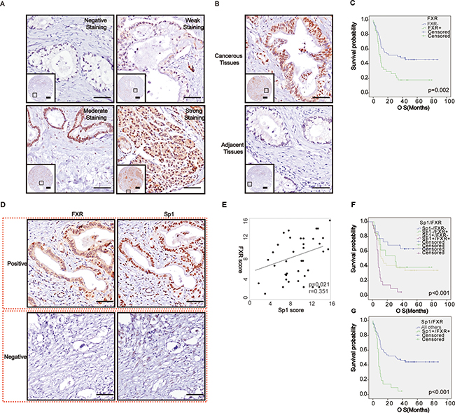 Correlated high expression of Sp1 and FXR in protein levels confers the poorest prognosis for pancreatic cancer.