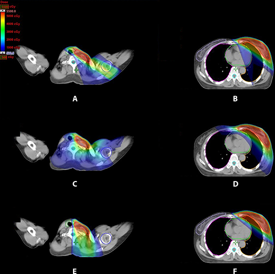 Dose distribution for three treatment plans for periclavicular node, left breast and IMN region for one representative patient.