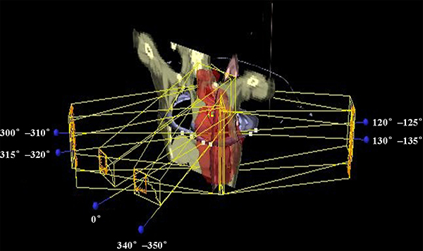 Beam arrangement for FJT-IMRT.