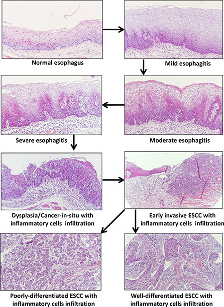 Schematic model of the development of esophagitis and its progression to esophageal squamous cell carcinoma (ESCC).