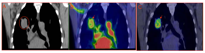 Mismatched intratumoral distribution between early phase perfusion imaging