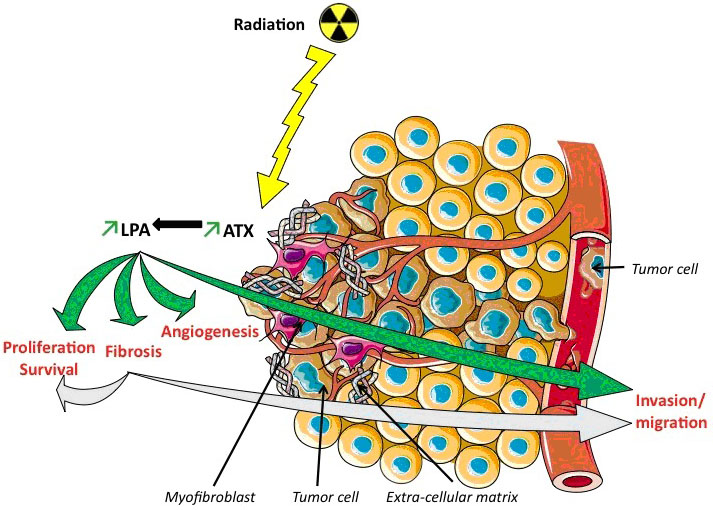 Pro-fibrotic and pro-oncogenic effects of lysophosphatidic acid (LPA) induced by radiation therapy.