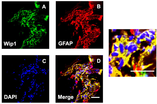 Double labeling immunofluorescent for Wip1 and GFAP in ERM.