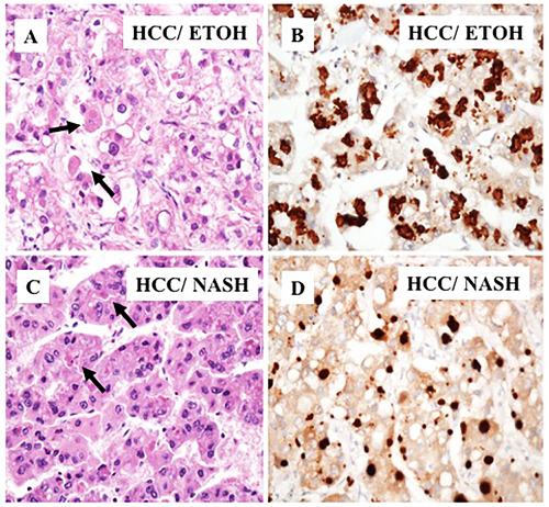 Immunohistochemical staining of HCC cells with Mallory-Denk bodies.
